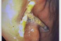 Dụng cụ tránh thai đi lạc, xuyên qua dạ dày người phụ nữ