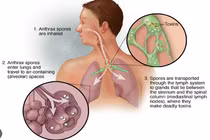 Khi nào bệnh than có tỷ lệ tử vong lên đến 90%?