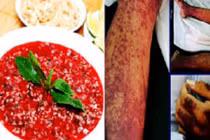 Suýt chết vì ăn tiết canh: Cách phòng tránh liên cầu khuẩn lợn