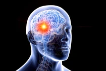 Dấu hiệu ung thư não nhiều người bỏ qua