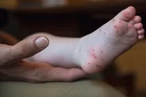 Trẻ mắc tay chân miệng: Ăn gì mau khỏi bệnh?