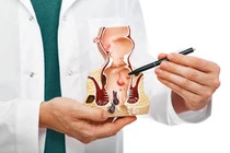 Cách phòng ngừa bệnh trĩ hiệu quả 