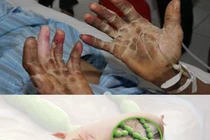 Bộ Y tế cảnh báo về căn bệnh nguy hiểm lây từ lợn sang người