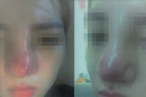 Biến chứng vì tiêm filler làm đẹp, chị em thay nhau vào viện