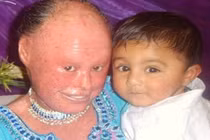 Bệnh lạ: Cô gái có làn da như loài rắn hổ mang