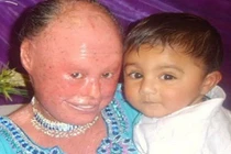 Bệnh lạ: Cô gái có làn da như loài rắn hổ mang