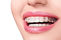 Gái xinh bị người yêu đề nghị chia tay vì ... niềng răng