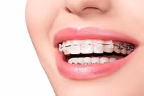 Gái xinh bị người yêu đề nghị chia tay vì ... niềng răng