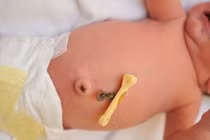 Thấy dấu hiệu này khi trẻ sơ sinh rụng rốn, mẹ đừng chủ quan