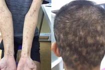 Bệnh giang mai tăng nhanh, có thể tổn thương tim, gan và tử vong