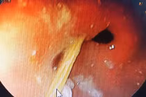 Quảng Bình: Nuốt nhầm tăm tre gây thủng dạ dày