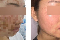 Da mặt cô gái sùi như vỏ cây sau khi rửa mặt bằng bột mua trên mạng