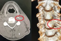 Uống "nước thần" của bà mo, bệnh nhân nhập viện khẩn cấp