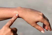 6 mẹo trị vết ong đốt tức thời