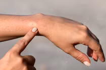 6 mẹo trị vết ong đốt tức thời