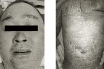 Đắp thuốc nam chữa vảy nến, người đàn ông nổi mụn, mưng mủ toàn thân