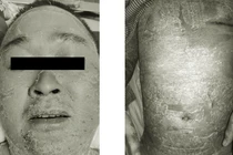 Đắp thuốc nam chữa vảy nến, người đàn ông nổi mụn, mưng mủ toàn thân