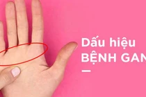 Có dấu hiệu này, chắc chắn bạn bị gan, phải đi khám ngay