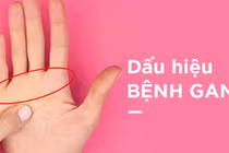 Có dấu hiệu này, chắc chắn bạn bị gan, phải đi khám ngay