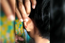 Giáo viên dập ghim vào tai học sinh lớp 4 vì không làm bài tập về nhà