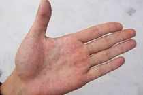 Ngón tay xuất hiện dấu hiệu này, cảnh giác vì có thể là ung thư phổi