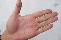 Ngón tay xuất hiện dấu hiệu này, cảnh giác vì có thể là ung thư phổi