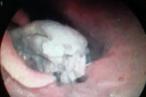 Ăn phao câu vịt, người đàn ông suýt mất mạng