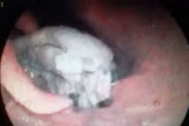 Ăn phao câu vịt, người đàn ông suýt mất mạng