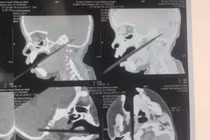 Đũa xuyên qua vòm miệng, chạm tới não bé gái 1 tuổi