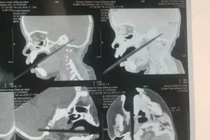 Đũa xuyên qua vòm miệng, chạm tới não bé gái 1 tuổi