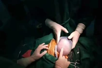 Hy hữu: Bé trai sinh non còn nguyên trong túi ối, nhăn nhó không muốn ra ngoài