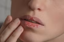 10 nguyên nhân khiến đôi môi nứt nẻ
