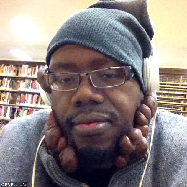 Hãi hùng sẹo lồi chi chít khắp mặt vì bệnh thủy đậu