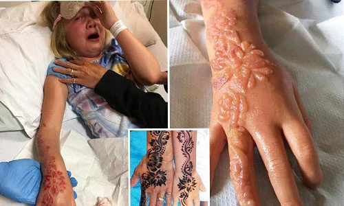 Thương tâm bé gái bị bỏng hóa học nặng do mực xăm henna