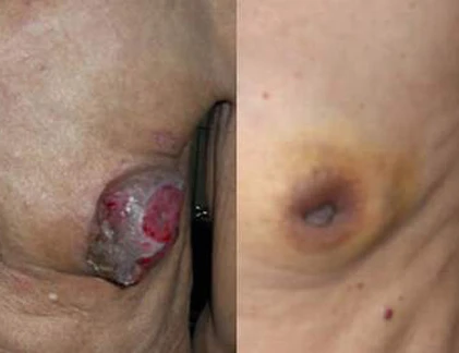 Biểu hiện lạ khi trai trẻ mắc ung thư vú