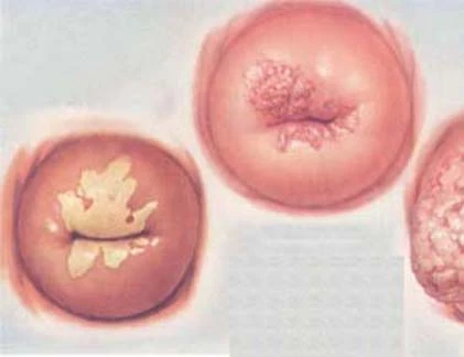 Điểm danh 11 nguyên nhân gây ung thư cổ tử cung