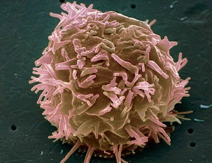 Giải pháp chữa trị ung thư đầu cổ