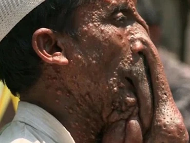 Nghịch cảnh người voi từ chối gương mặt đẹp để ăn xin