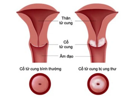 Tận dụng thảo dược trị ung thư cổ tử cung hiệu quả