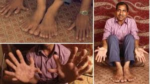 Dị nhân Ấn Độ có 28 ngón tay và chân