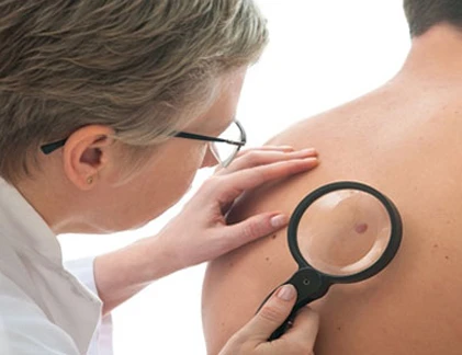 Những đối tượng dễ mắc ung thư da