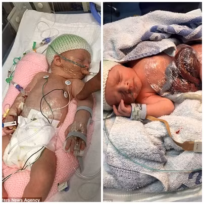 Xót lòng em bé sinh ra với bộ ruột ngoài cơ thể