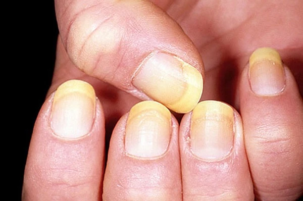 Dấu hiệu ở móng tay cảnh báo sức khỏe của bạn