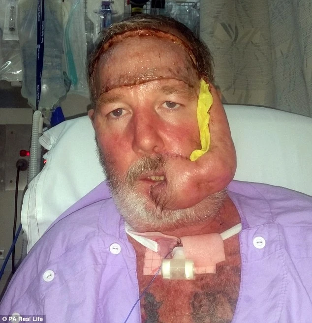 Khuôn mặt biến dạng khủng khiếp vì ung thư da