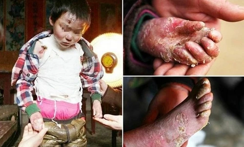 Xót xa những em bé có làn da mỏng manh như cánh bướm