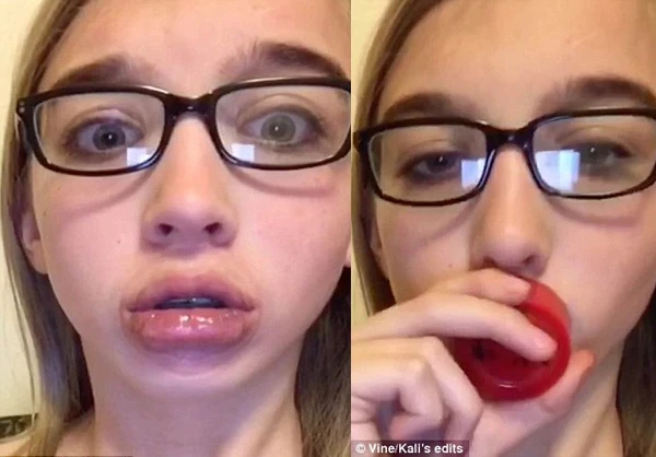 Trào lưu hít chai để môi sưng vù như Kylie Jender