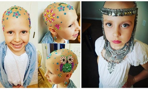 Con gái 7 tuổi bị rụng tóc, mẹ làm điều tuyệt vời không tưởng