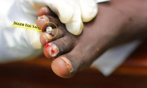 Sự khủng khiếp của loài bọ đẻ trứng lúc nhúc dưới da người