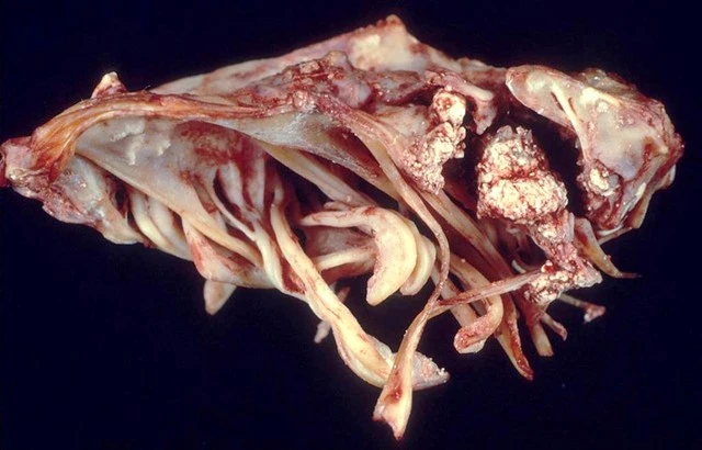 Hình ảnh cơ thể bị tàn phá kinh hoàng của người mắc gout