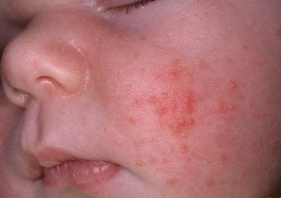 Điểm mặt hoa quả dễ gây dị ứng ở trẻ